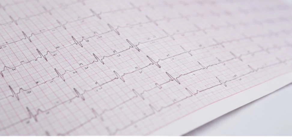 EKG vizsgálat